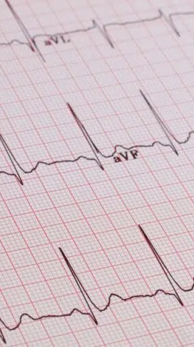 ecg2